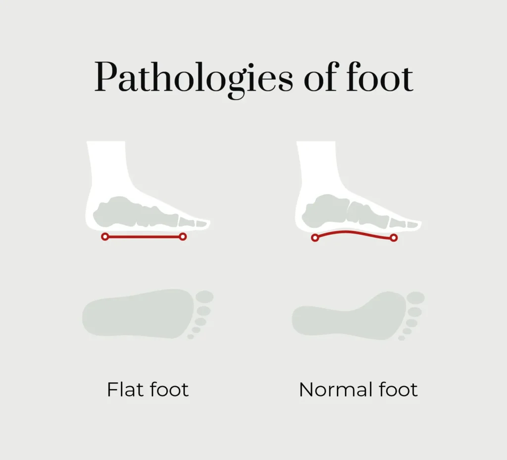 A comparison of pathologies between a flat foot and a normal foot. 