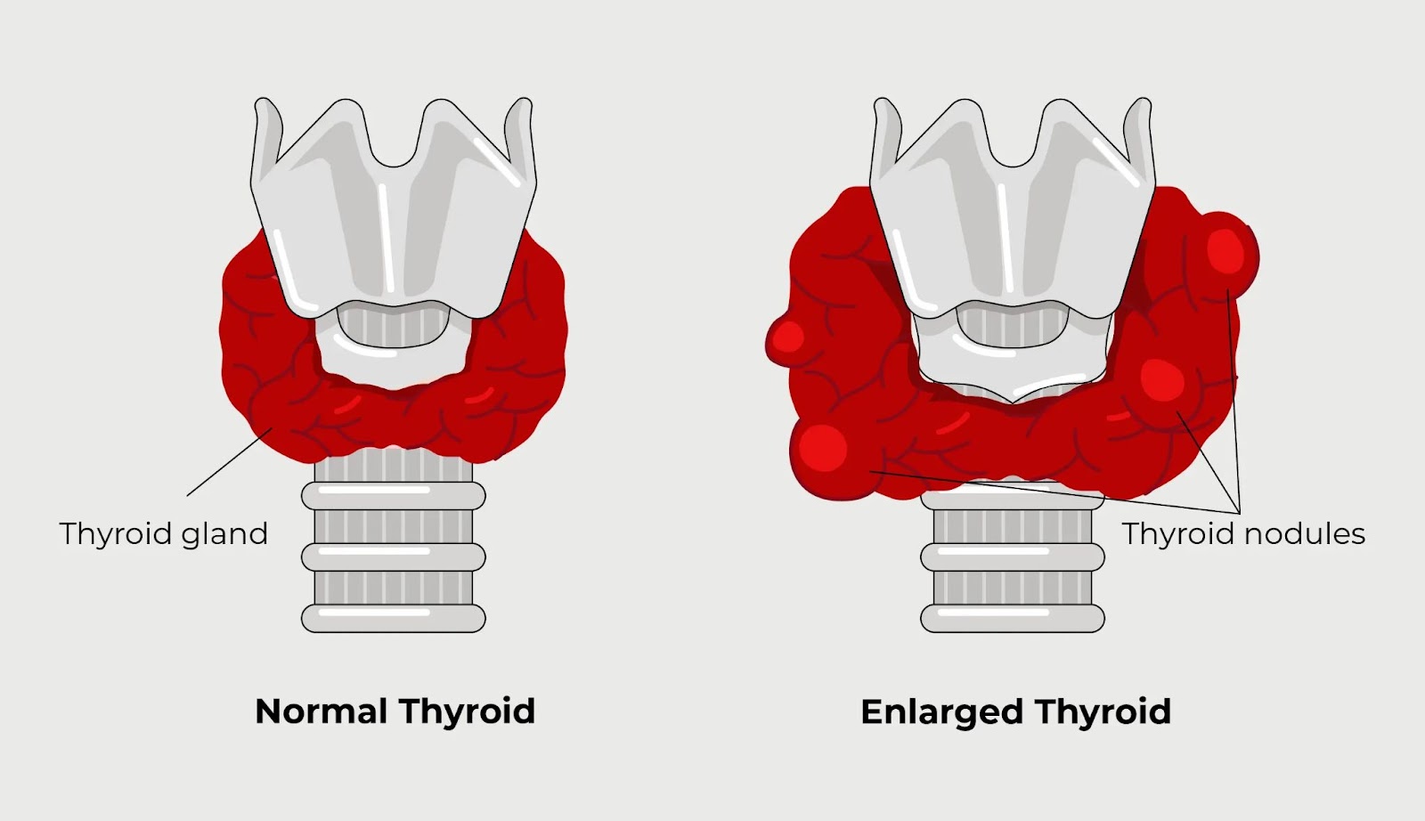 Comparison of a normal thyroid gland and an enlarged thyroid with nodules