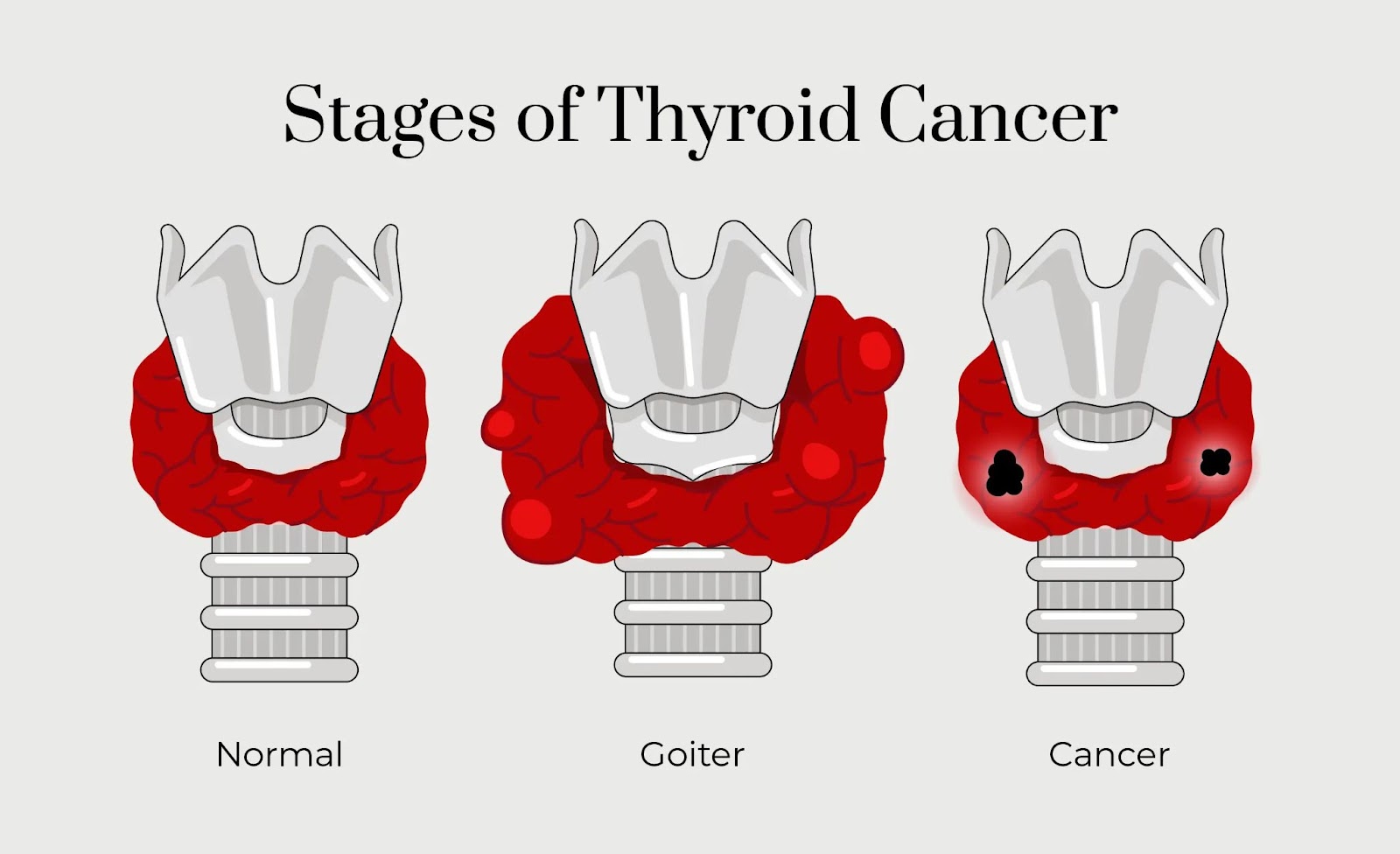 Stages of thyroid cancer: normal, goiter, cancer