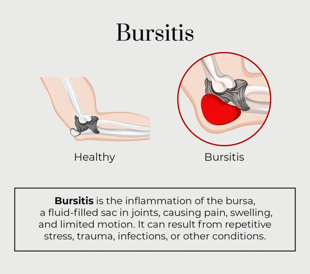 a graphic describing what bursitis is.
