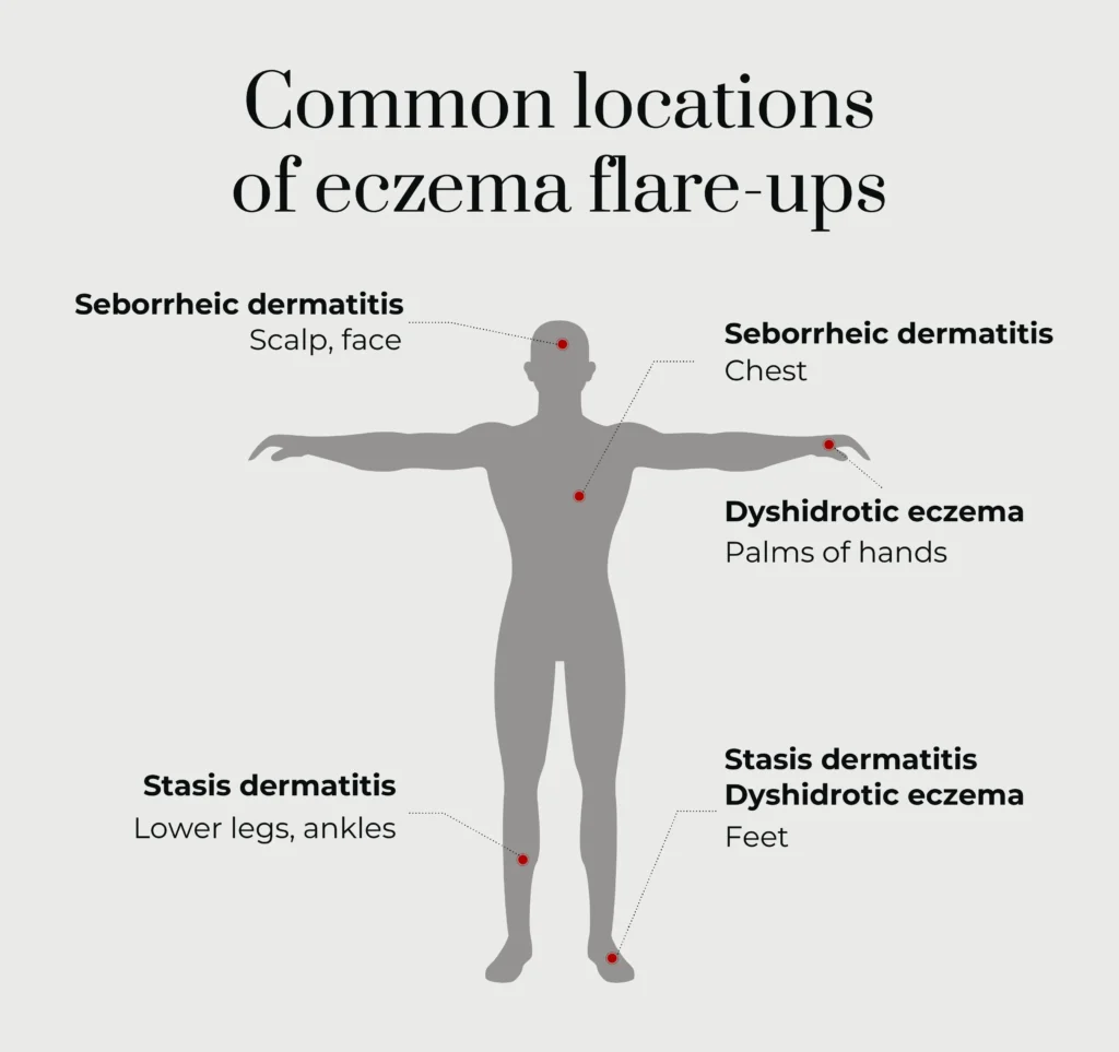 A graphic listing the common locations of eczema flare-ups.