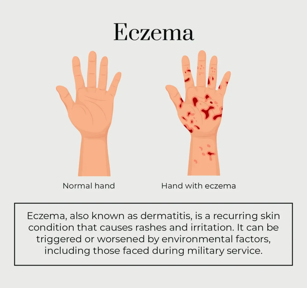 A graphic describing what eczema is.