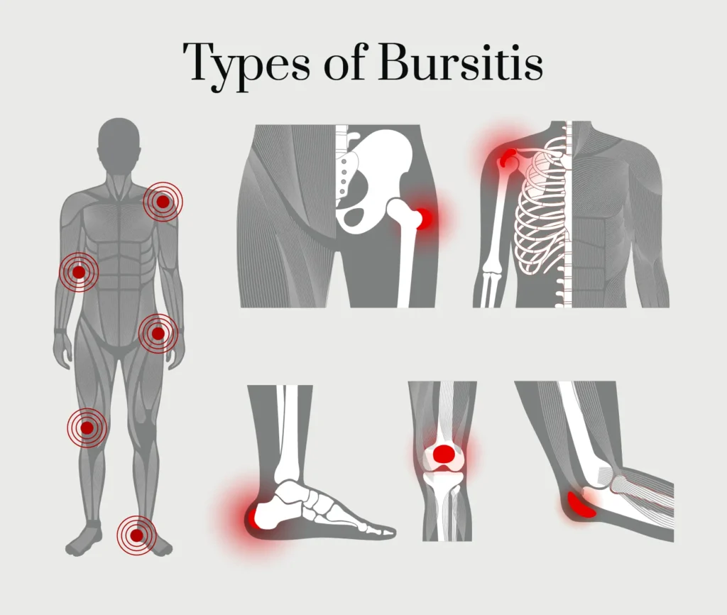 A graphic listing the types of bursitis.