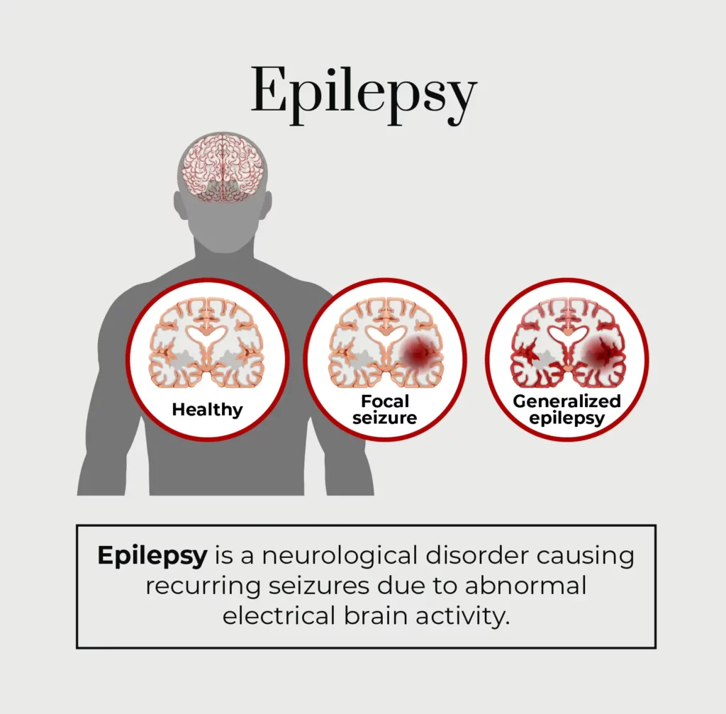 A custom graphic describing epilepsy. 