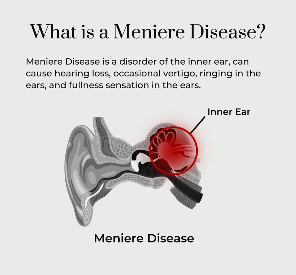 A graphic defining what a Meniere Disease is. 