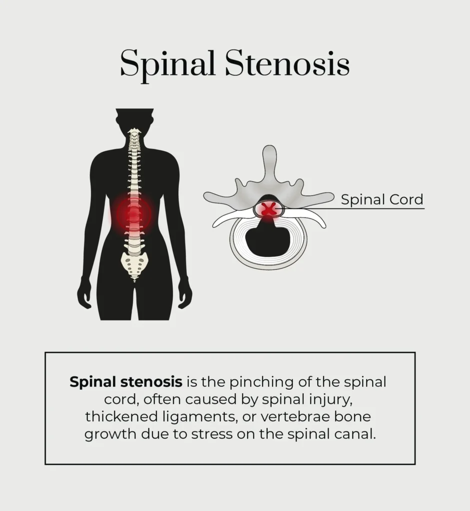 A graphic describing what spinal stenosis is.
